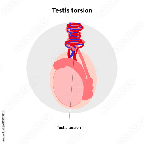 Testis torsion Testicular disease. Man reproductive health system pain testicle pathology problem. Medical diagram 