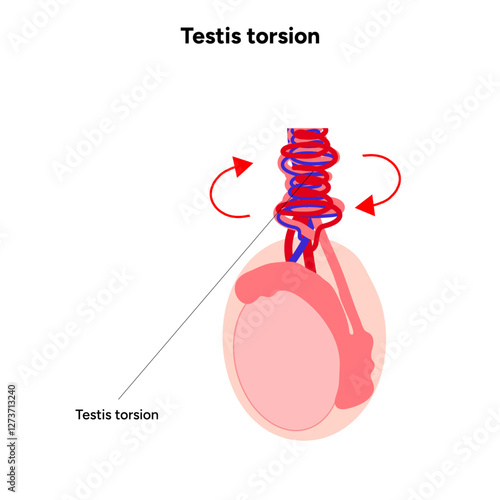 Testis torsion Testicular disease. Man reproductive health system pain testicle pathology problem. Medical diagram 