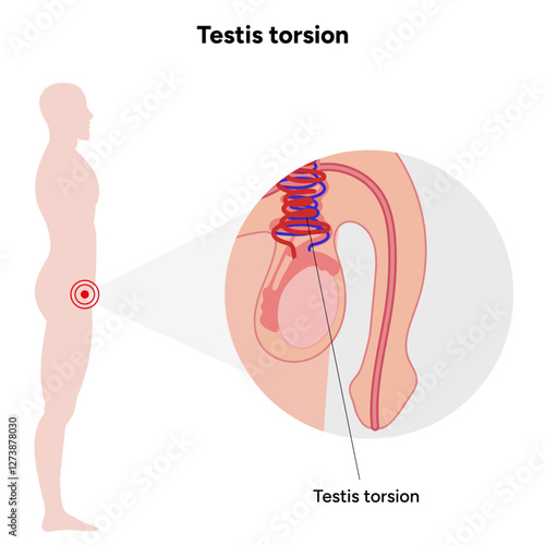 Testis torsion Testicular disease. Man reproductive health system pain testicle pathology problem. Medical diagram 