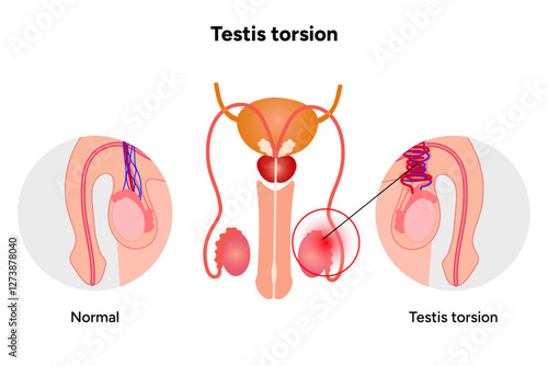 Testis torsion Testicular disease. Man reproductive health system pain testicle pathology problem. Medical diagram 