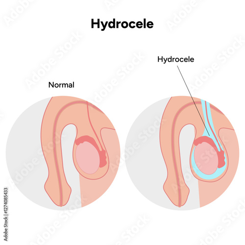 Hydrocele Testicular disease. Man pain testicle pathology problem. Medical diagram 