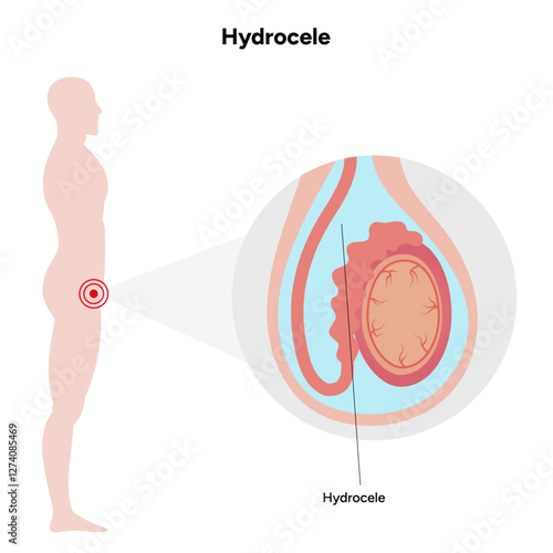 Hydrocele Testicular disease. Man pain testicle pathology problem. Medical diagram 