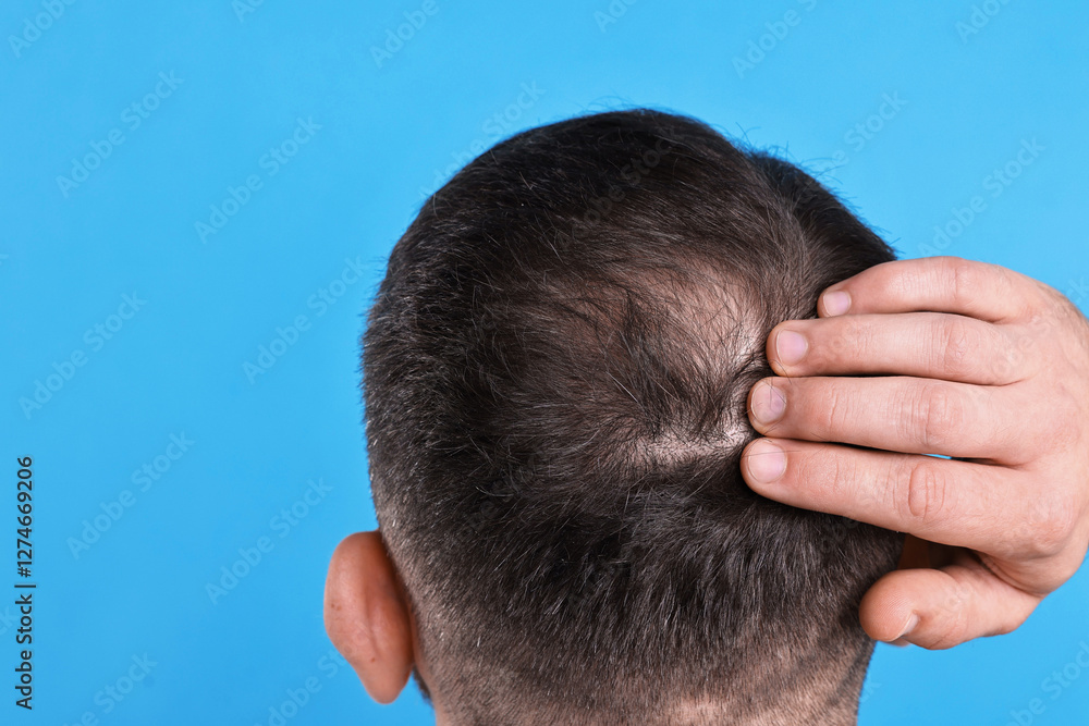 Fototapeta premium Baldness problem. Man with bald spot on light blue background, back view. Space for text