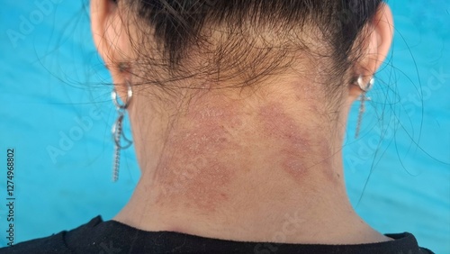 A woman has a rash on the back of her neck, itching, and dermatitis.