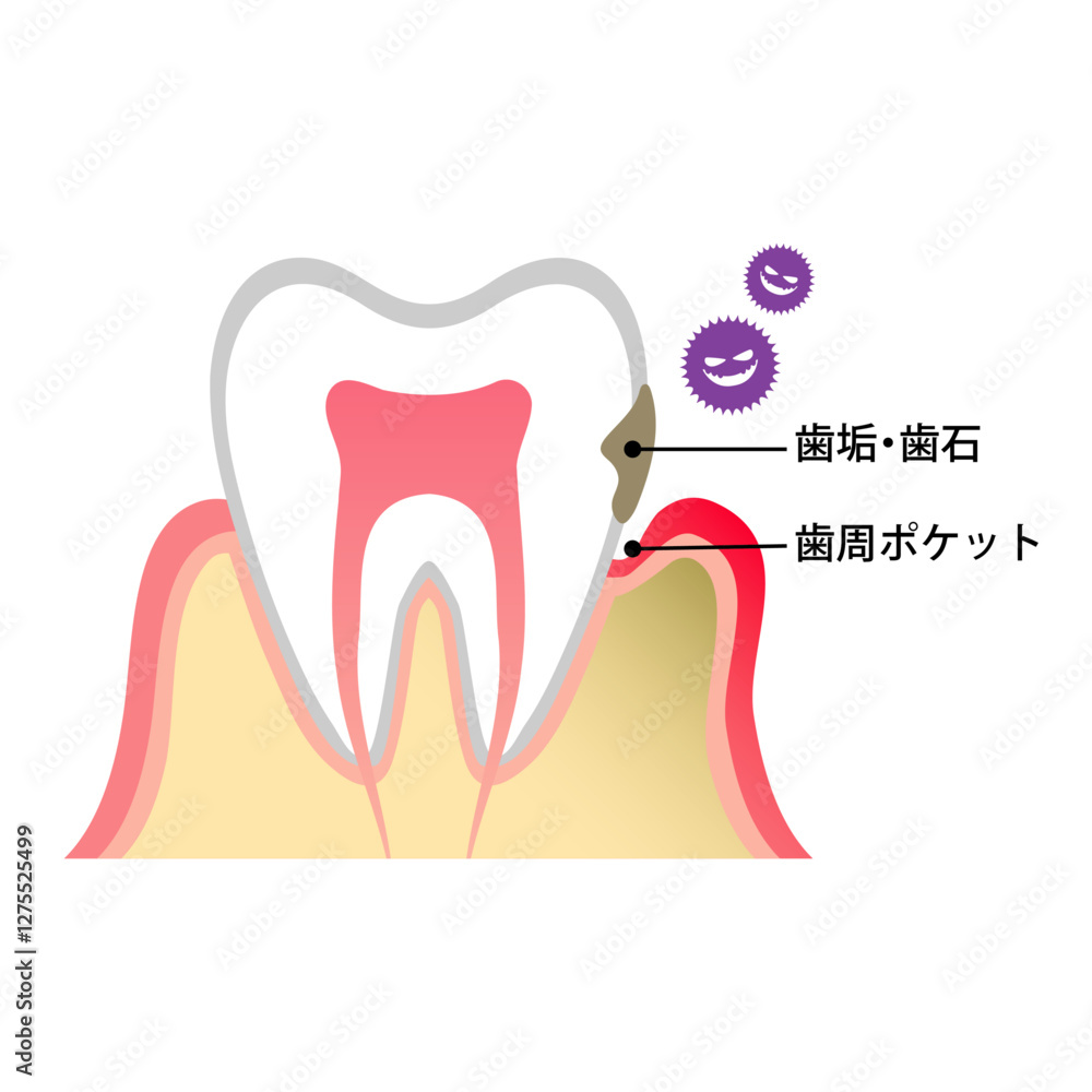 歯周ポケットが汚れ歯周病になっている歯のイラスト