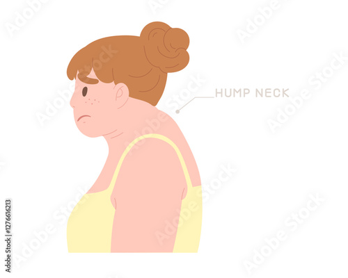 Woman have Hump Neck or Buffalo Hump symptom. Concept of office symdrome, kyphosis, incorrect posture, fat, Cervical Bulging Disc- Neck, spine, health care. Flat vector illustration