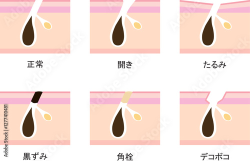 毛穴の断面　セット
