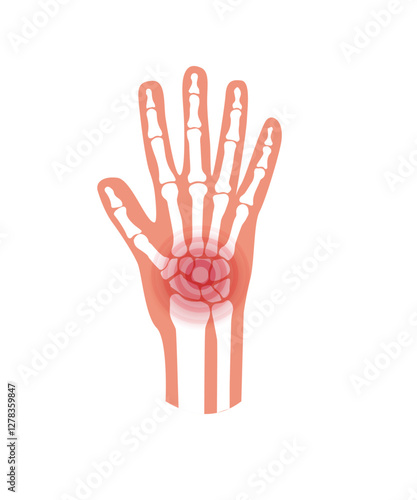 Pain and inflammation in hand on x ray stock illustration