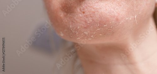 Skin condition on the chin highlights dryness and flakiness during self-care routine at home photo