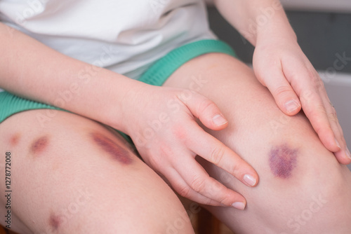 Fotografie Bruises on the legs are common signs of bumps that require time to heal and fade away with proper care