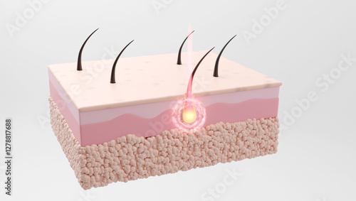 Tableau sur toile Advanced laser destroys hair roots, reducing regrowth permanently