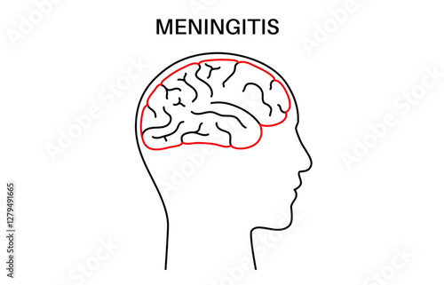 Meningitis medical poster