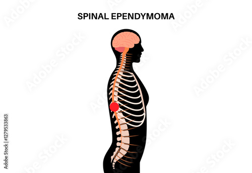 Spinal ependymoma cancer