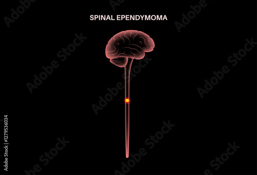 Spinal ependymoma cancer