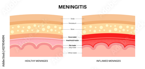 Meningitis medical poster