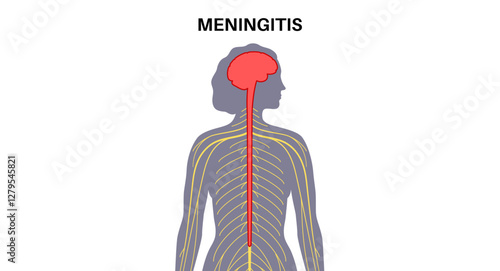 Meningitis medical poster