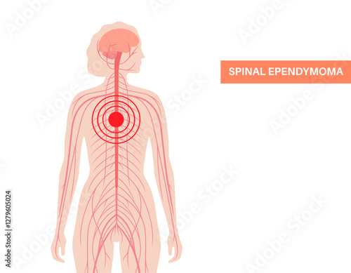 Spinal ependymoma cancer