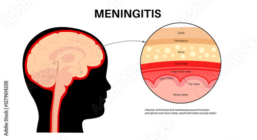 Meningitis medical poster