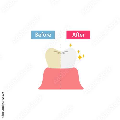 ホワイトニングした歯のビフォーアフターのイラスト
