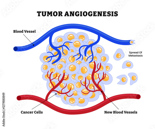 Tumor Angiogenesis, tumors form new blood vessels to supply to  oxygen and nutrients, tumor growth and metastasis. transition of tumors from a benign state to a malignant. Cancer cells.