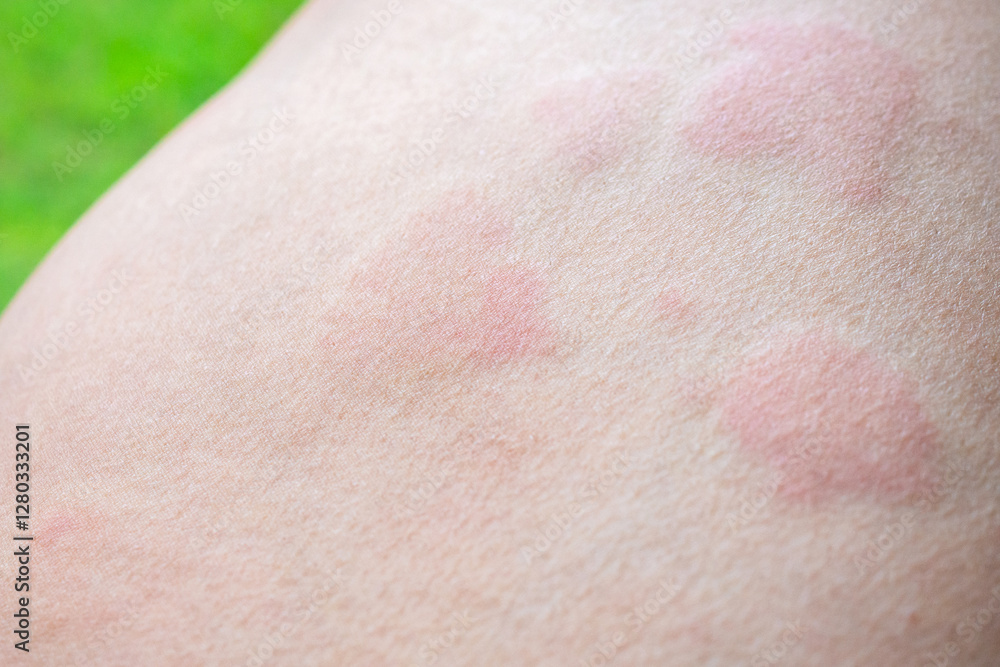 Fototapeta premium Skin allergy rash dermatitis texture close up