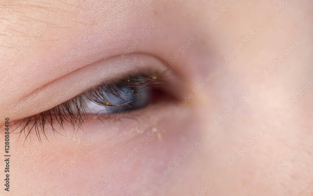 Fototapeta premium Painful red eye of a girl during a viral cold. Inflammation conjunctivitis, macro