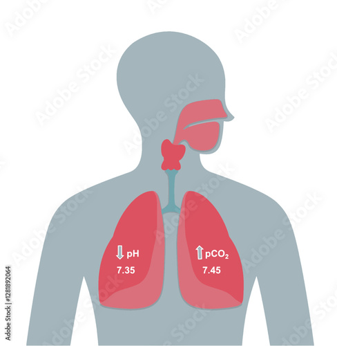 Respiratory Acidosis lungs. Respiratory acidosis is a condition that causes lower-than-normal blood pH because of increased acids in your blood. A normal pH range in blood is between 7.35 to 7.45.