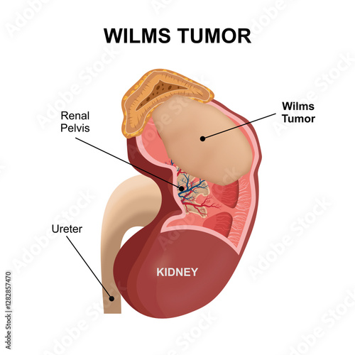 Wilms Tumor Kidney Tumor illustration