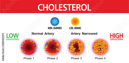 Cholesterol in artery, health risk , vector design