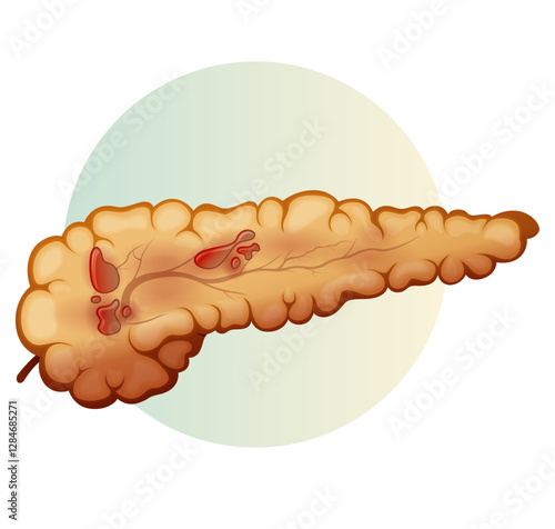 Pancreas - Acute Pancreatitis - Stock Illustration