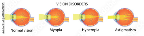 Visual impairment diagram with names and eyeball structure vector illustration.