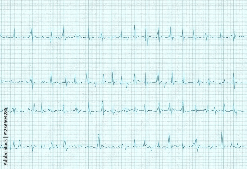 Modern Digital ECG Heartbeat Waveform Illustration Light Blue Grid Background - Medical Technology, Cardiology, Health Monitoring Educational Materials Heart Health Modern Digital ECG Heartbeat Waveform Illustration Light Blue Grid Background - Medical Technology, Cardiology, Health Monitoring Educational Materials Heart Health