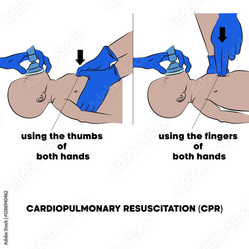 Cardiopulmonary resuscitation (CPR), emergency procedure.