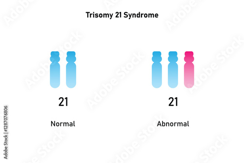 Trisomy 21 Syndrome Science Design. Vector Illustration. photo