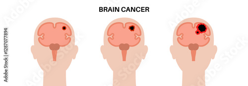 Brain cancer grade