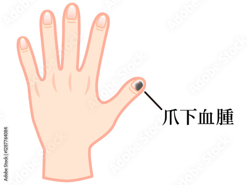 爪下血腫で内出血した手のイラスト素材3