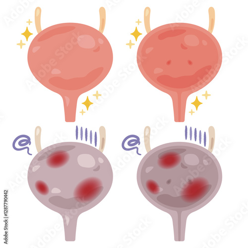 健康でキレイな膀胱と炎症が起きた不健康な膀胱のイラスト