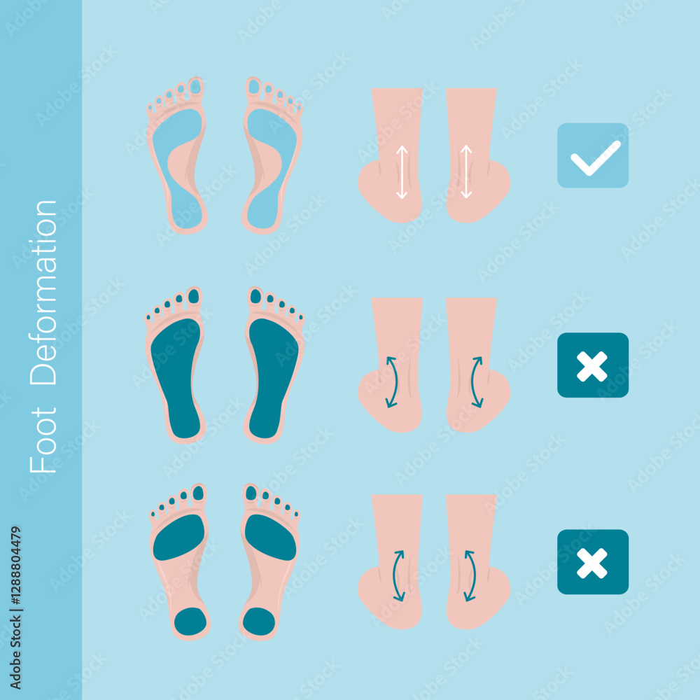 Infographic with feet deformation. Foot pathologies. Difference between diseased and healthy feet. Medical problem of foot or ankle curvature or deformity, valgus deformity Infographic with feet deformation. Foot pathologies. Difference between diseased and healthy feet. Medical problem of foot or ankle curvature or deformity, valgus deformity