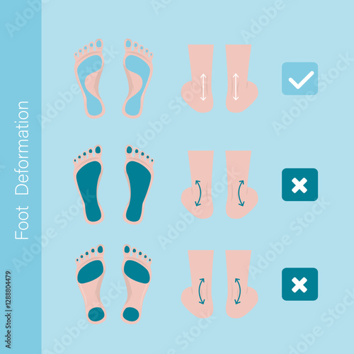 Infographic with feet deformation. Foot pathologies. Difference between diseased and healthy feet. Medical problem of foot or ankle curvature or deformity, valgus deformity