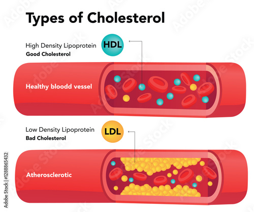 Types of cholesterol comparison with HDL and LDL stock illustration