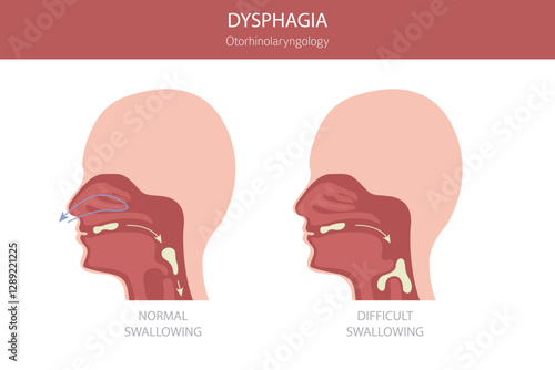 Oral dysphagia diseases. Otorhinolaryngology. Difficult swallowing. Medical infographic design. Vector illustration