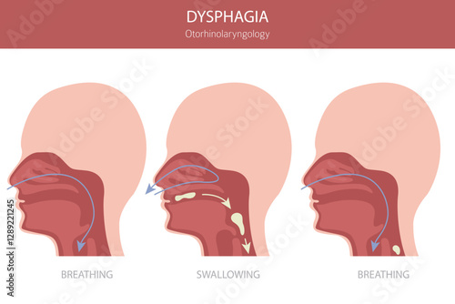 Oral dysphagia diseases. Otorhinolaryngology. Difficult swallowing. Medical infographic design. Vector illustration
