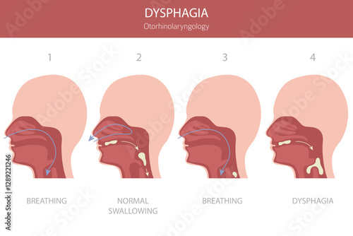 Oral dysphagia diseases. Otorhinolaryngology. Difficult swallowing. Medical infographic design. Vector illustration