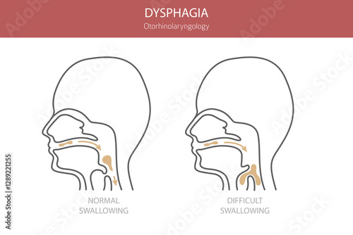 Oral dysphagia diseases. Otorhinolaryngology. Difficult swallowing. Medical infographic design. Vector illustration