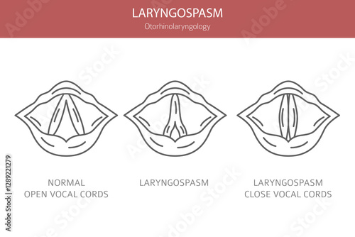 Laryngospasm diseases. Otorhinolaryngology. Vocal cord disfunction. Medical infographic design. Vector illustration