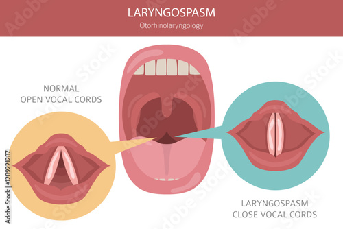 Laryngospasm diseases. Otorhinolaryngology. Vocal cord disfunction. Medical infographic design. Vector illustration