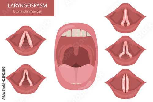 Laryngospasm diseases. Otorhinolaryngology. Vocal cord disfunction. Medical infographic design. Vector illustration