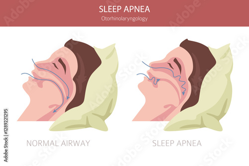 Sleep Apnea diseases. Otorhinolaryngology. Sleep related breathing disorder. Medical infographic design. Vector illustration