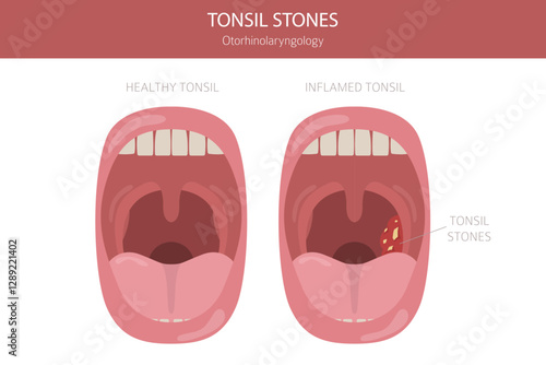 Tonsil stones diseases. Otorhinolaryngology. chronic caseous tonsillitis. Medical infographic design. Vector illustration