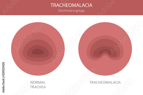 Tracheomalacia disease. Pulmonology, otolaryngology. Medical infographic design. Vector illustration